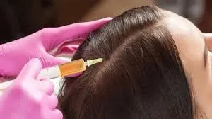 Tratamientos capilares avanzados: mesoterapia y PRP para revitalizar el cabello